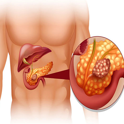 pancreatitis surgen in pune